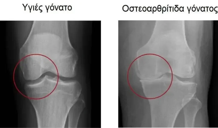 Knee Osteoarthritis / Οστεοαρθρίτιδα - πάθηση που επηρεάζει τις αρθρώσεις