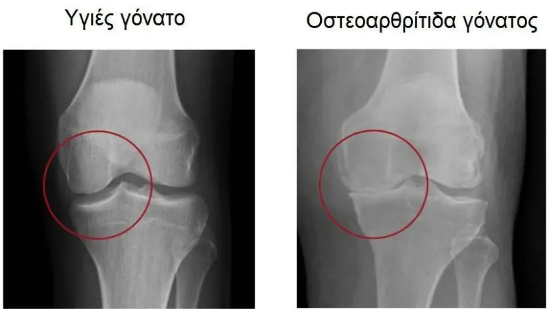 Knee Osteoarthritis