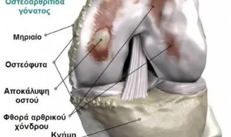 Knee Osteoarthritis Knee Osteoarthritis: Explanation and relevance