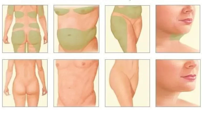 Liposuction and Tumescent technique / Λιποαναρρόφηση και η Τεχνική της Διογκωτικής Αναισθησίας (Tumescent)