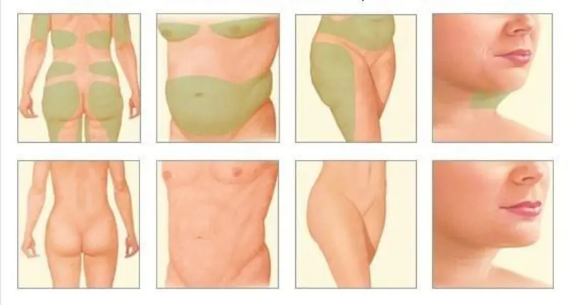 Liposuction and Tumescent technique