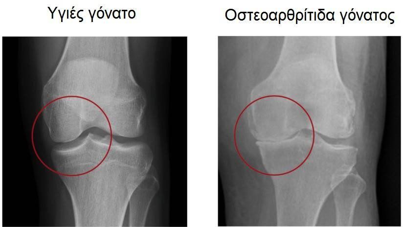 Knee Osteoarthritis