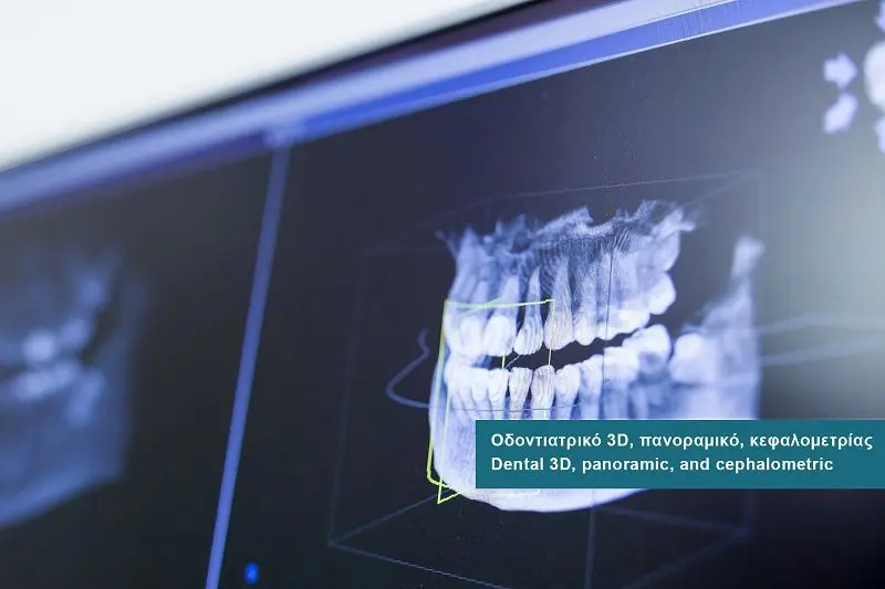 Dental 3D CBCT - Panoramic - Cephalometry examinations at DIKTEON Medical Diagnostic Center in Strovolos - Nicosia - Cyprus.