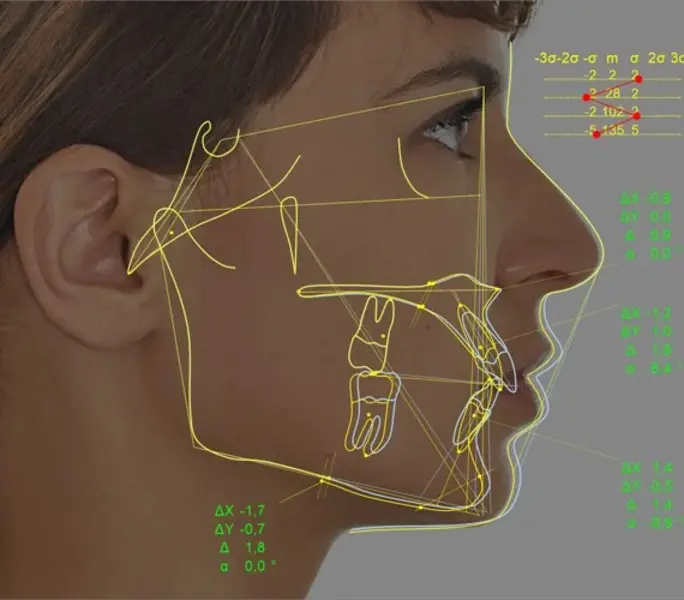 Planmeca Romexis Cephalometric Analysis Surgical Simulation Planmeca Romexis Cephalometric Analysis Surgical Simulation