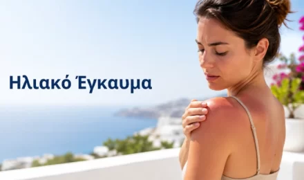 Ηλιακό Έγκαυμα